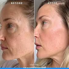 Derma Stamp (Microneedling Tool)