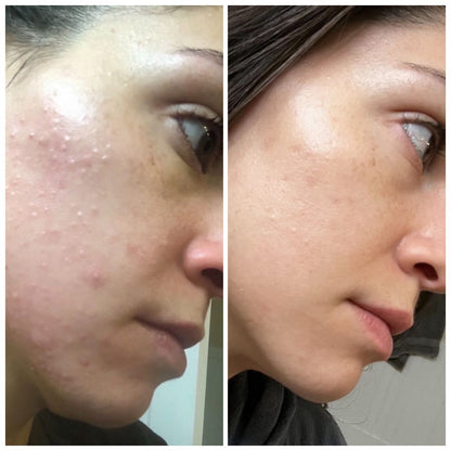 Derma Stamp (Microneedling Tool)